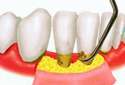 牙周病综合治疗2